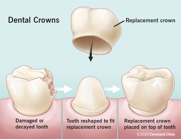 Crowns