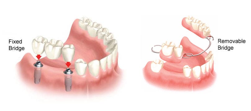 Dentures