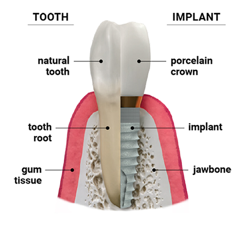 Dental implants