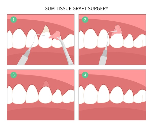 Gum graft